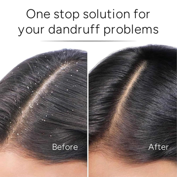 Bare Anatomy Anti-Dandruff Hair Spray | Neem & Lemon Scalp Spray | Reduces Dandruff, Soothes Itchy Scalp & Boosts Hair Density | Lightweight & Non-Greasy