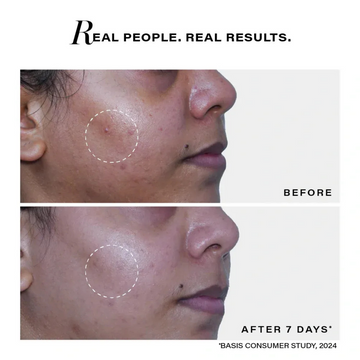 Novology Acne Rescue Spot Corrector Gel | Reduces Active Acne Without Dryness